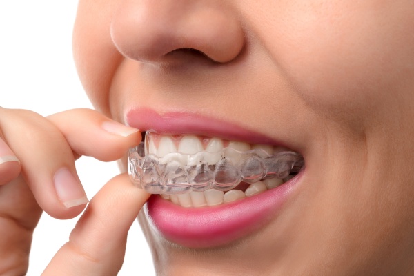 Invisalign: The Clear Path to a Confident Smile Makeover