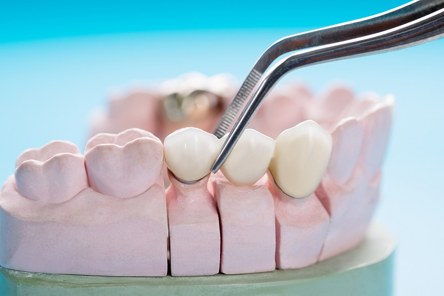 Different Materials Used In Crowns and Bridges