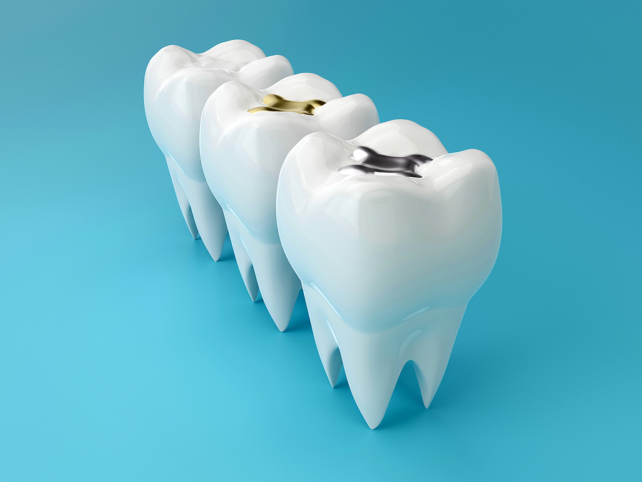 Dental Fillings: Uses and Types