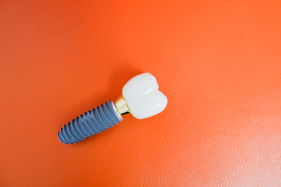 Dental Implants Make Life Easier – Here’s How