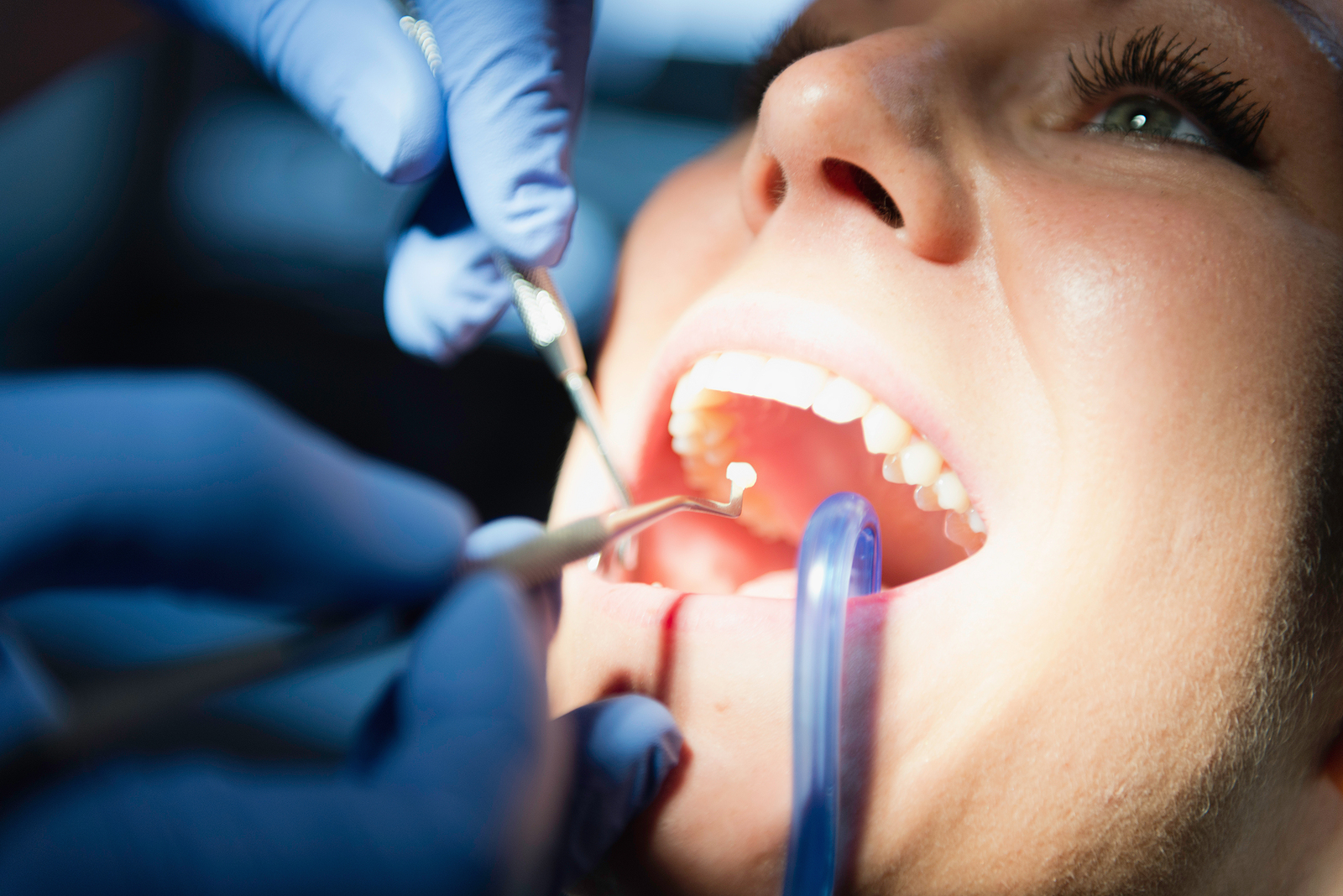 Achieving a Natural Smile with Tooth Color Filling in Milpitas, CA